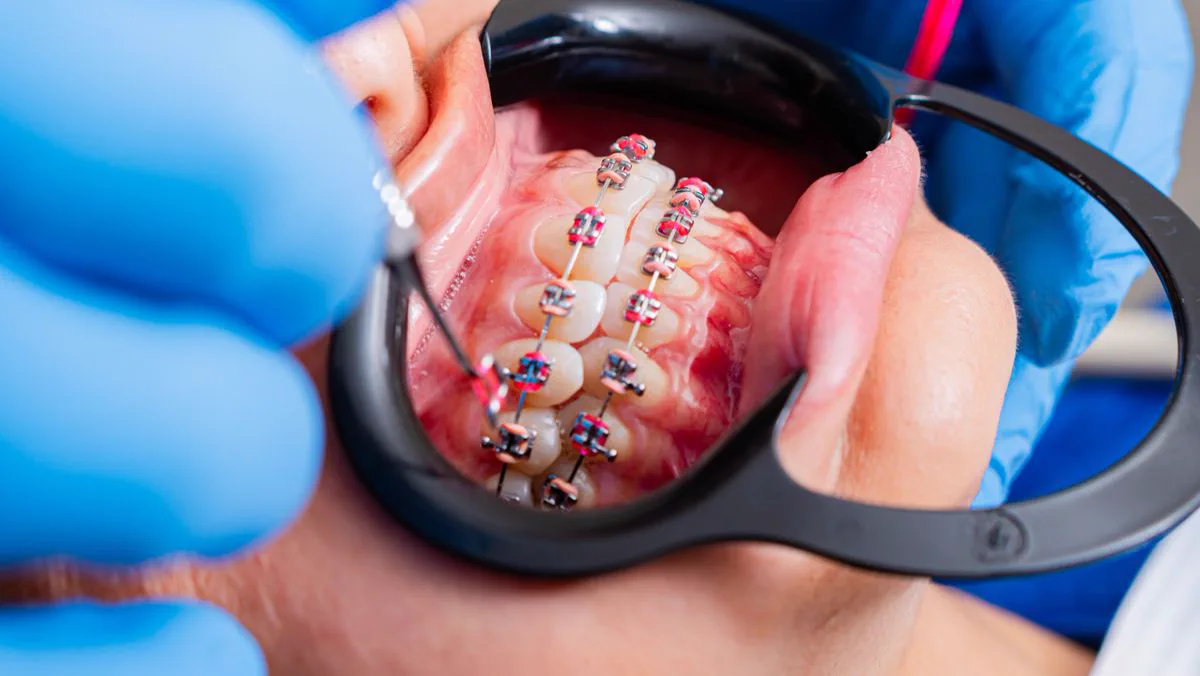 Imagen de referencia de ortodoncia y brackets